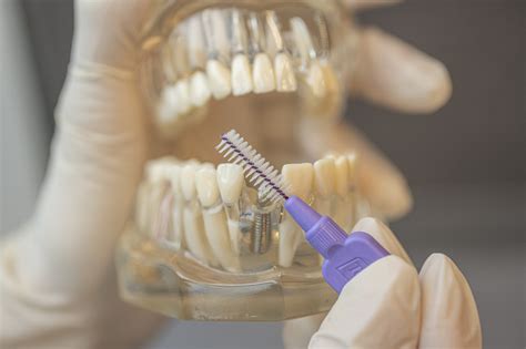 Anbieter von Zahnimplantaten